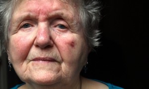 elderly woman facial fractures