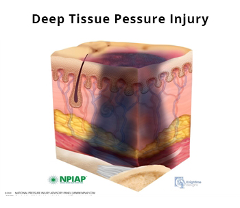 Deep Tissue Pressure Injury