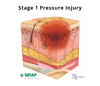 Stage 1 Pressure Injury
