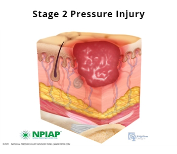 Stage 2 Pressure Injury