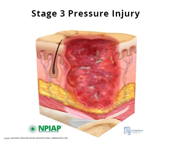 Stage 3 Pressure Injury