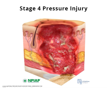 Stage 4 Pressure Injury