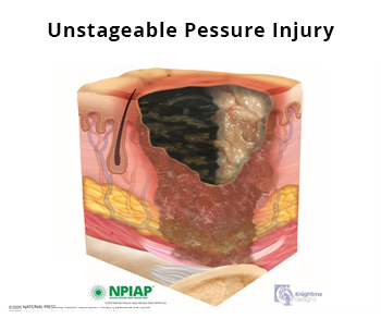 Unstageable Pressure Injury